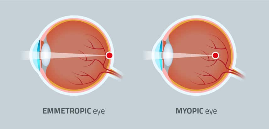 EMMETROPE-MYOPE-IT