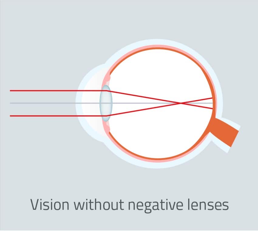 No-Negative-lenses-vison